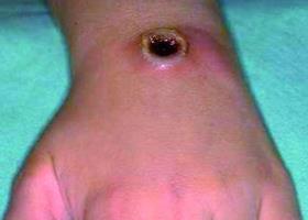 Фото симптомов сибирской язвы у человека