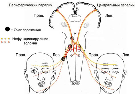 Неврит лицевого нерва (паралич Белла)