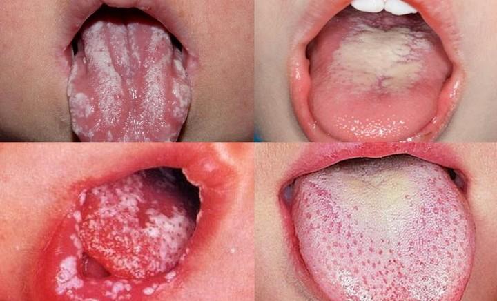 Стоматит на языке грибок