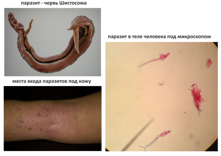Шистосомоз: симптомы, лечение шистосомы у человека - Medside.ru