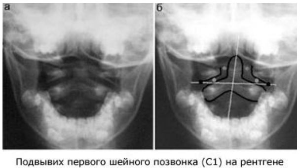 Смещение атланта у детей фото
