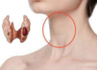 Диффузные изменения щитовидной железы