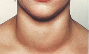 Диффузное изменение щитовидной железы код мкб thumbnail