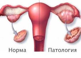 Симптомы рака яичника