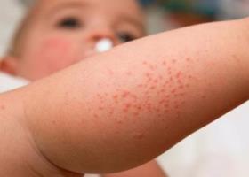 Фото аллергии на Нурофен у ребенка