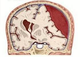 Гематома головного мозга