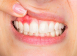 Периостит (флюс на десне, щеке, зубной)