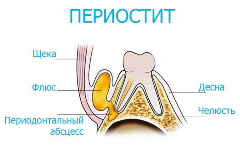 Флюс - симптомы, причины возникновения заболевания, виды и ...