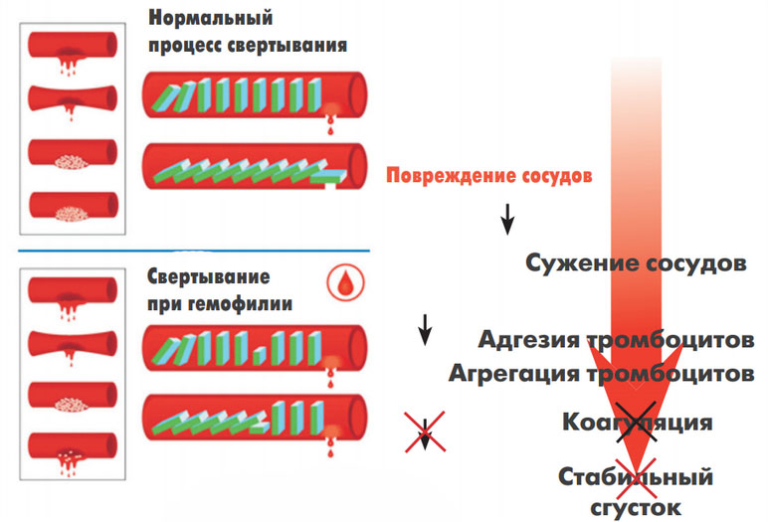 Гемофилия: что это за болезнь, симптомы царской болезни ...