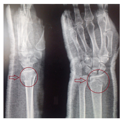 Рентгеновский снимок перелома лучевой кости в типичном месте