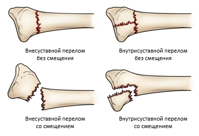 Разновидности переломов лучевой кости