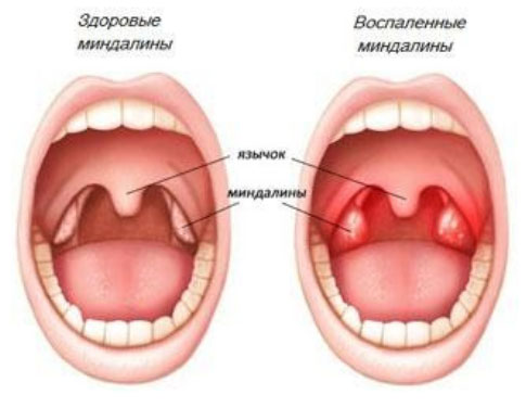 Налет на миндалинах чем лечить. Смотреть фото Налет на миндалинах чем лечить. Смотреть картинку Налет на миндалинах чем лечить. Картинка про Налет на миндалинах чем лечить. Фото Налет на миндалинах чем лечить