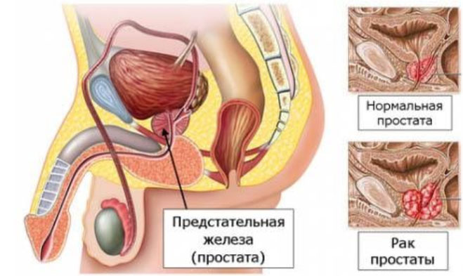Рак предстательной железы (рак простаты)