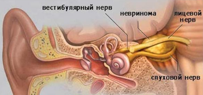 Невринома слухового нерва (шваннома)