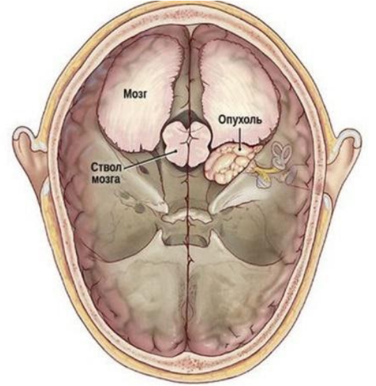Невринома слухового нерва (шваннома)