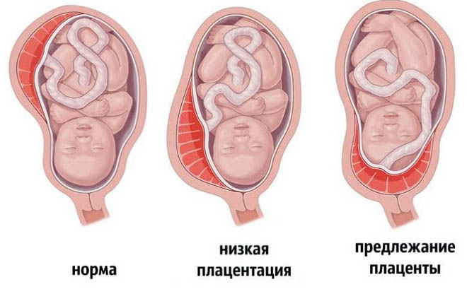 Предлежание плаценты при беременности