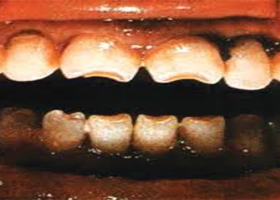 Гипоплазия эмали и клиновидный дефект зубов