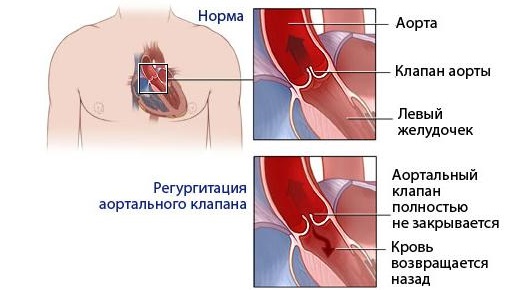 patogenez pri aortalnoj nedostatochnosti
