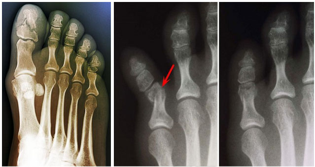Ушиб и перелом пальца на ноге