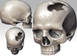 Перелом костей черепа