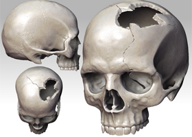 Перелом костей черепа