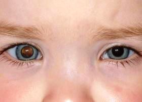 Ретинобластома глаза
