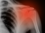Перелом плечевой кости
