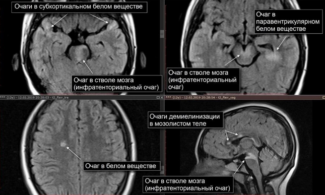 Очаговые изменения вещества мозга дистрофического характера и дисфункция стволовых структур