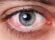 Кровоизлияние в глаз