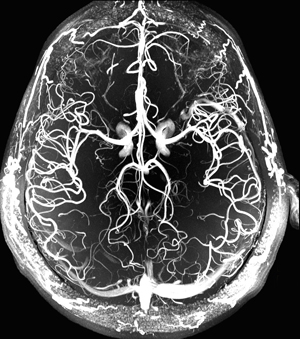 МР-ангиография головного мозга