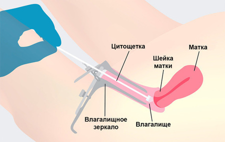 Схема проведения гинекологического мазка