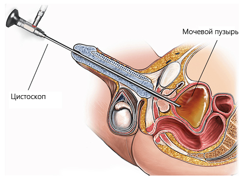 Цистоскопия при помощи жесткого эндоскопа