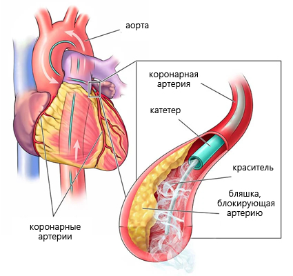 Схематичное изображение коронарографии сердца