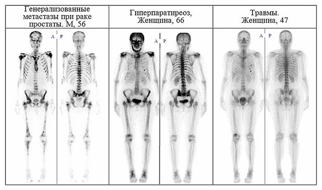 Примеры остеосцинтиграфии скелета при различных заболеваниях