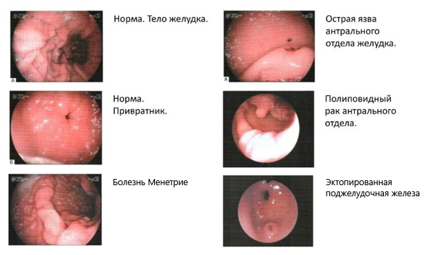 Эндоскопическая картина желудка при различных патологиях