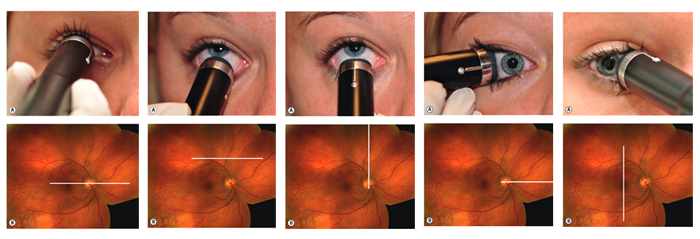 Различные положения датчика при В-сканировании и визуализируемые участки глазного дна