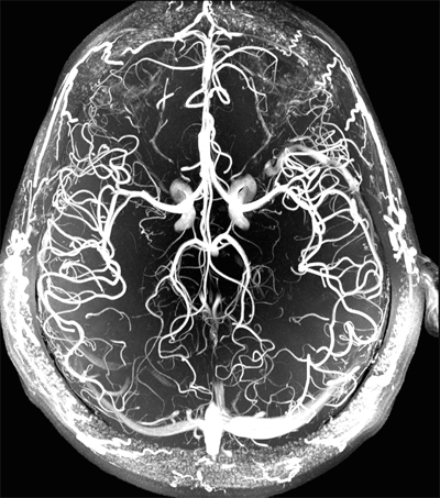 МРТ-снимок сосудов головного мозга