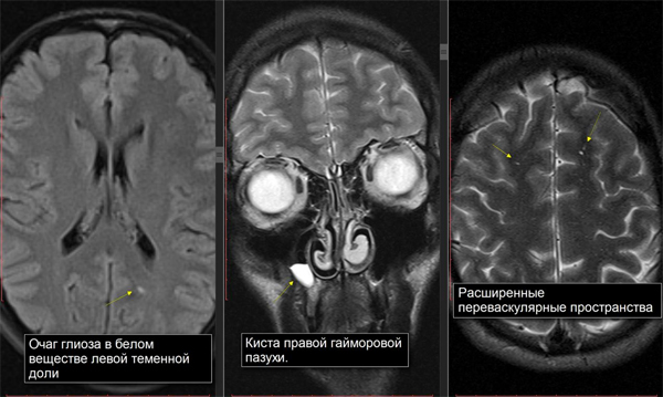 Варианты выявляемых патологий при проведении МРТ головного мозга
