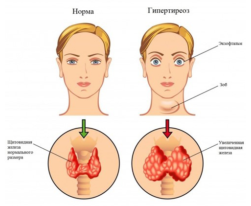 Сравнение гипертиреоза и нормального состояния щитовидной железы