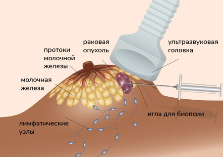 Схема проведения биопсии молочной железы