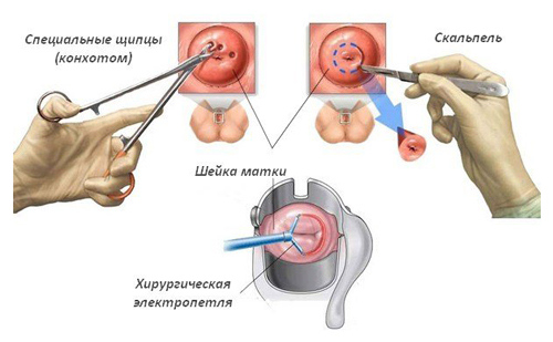 Схема проведения биопсии шейки матки