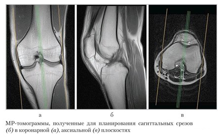 МР-томограммы коленного сустава