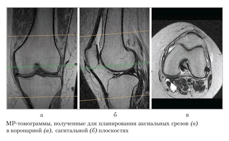 МР-томограммы коленного сустава