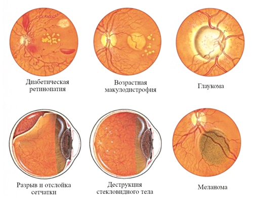 Патологии и изменения глазного дна