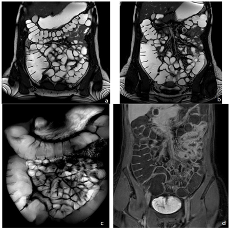 МРТ-снимки кишечника с выявленными патологиями