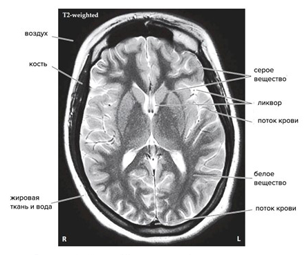Строение мозга на МРТ-срезе