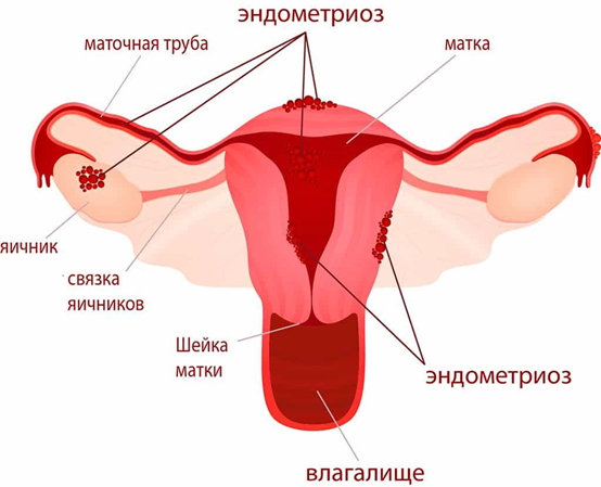 Эндометриоз и репродуктивная системы женщины