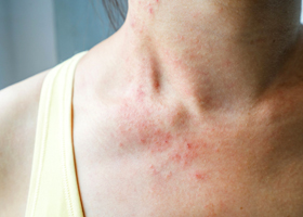 Красные пятна и аллергия на коже