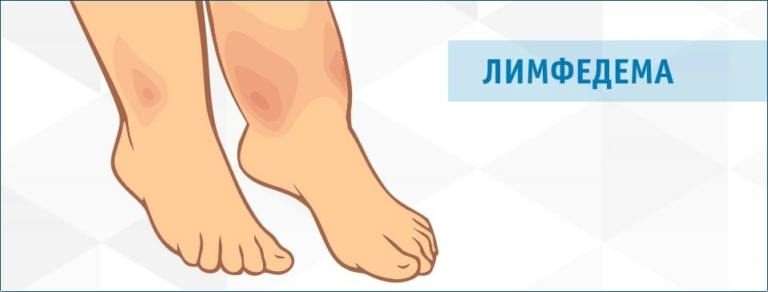 Блуждающая боль по муставам. Седалищный нерв. Облегчение боли. Упражнения | Доктор Демченко Всё о пластыре от боли в спине и суставах | Доктор И Блуждающая боль в суставах и мышцах: причины и лечение ???? на binogi.ru