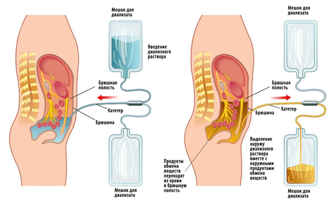 Схема перитонеального диализа